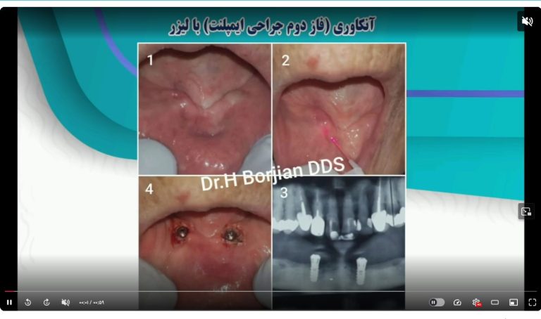 قیمت ایمپلنت اصفهان | بهترین ایمپلنت اصفهان | ایمپلنت دندان سوئیسی در اصفهان | جراحی ایمپلنت با لیزر دکتر حسین برجیان بهترین متخصص ایمپلنت اصفهان