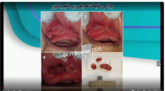 قیمت ایمپلنت اصفهان | بهترین ایمپلنت اصفهان | ایمپلنت دندان سوئیسی در اصفهان | جراحی ضایعات تحریکی زیر دنچر با لیزر دکتر حسین برجیان بهترین متخصص ایمپلنت اصفهان