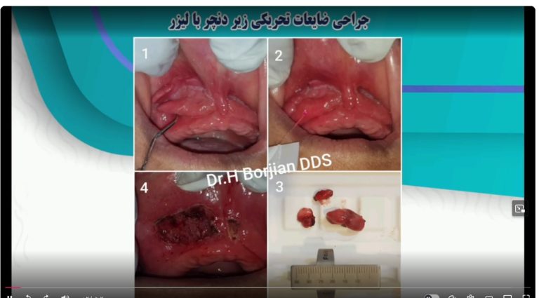 قیمت ایمپلنت اصفهان | بهترین ایمپلنت اصفهان | ایمپلنت دندان سوئیسی در اصفهان | جراحی ضایعات تحریکی زیر دنچر با لیزر دکتر حسین برجیان بهترین متخصص ایمپلنت اصفهان