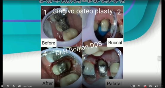 قیمت ایمپلنت اصفهان | بهترین ایمپلنت اصفهان | ایمپلنت دندان سوئیسی در اصفهان | جراحی CL دکتر حسین برجیان بهترین متخصص ایمپلنت اصفهان