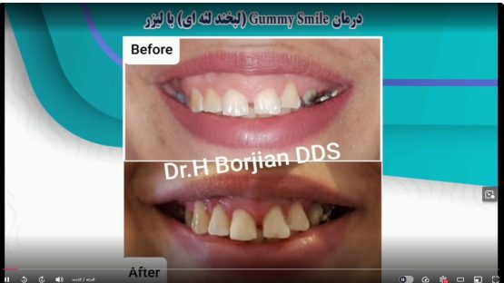 قیمت ایمپلنت اصفهان | بهترین ایمپلنت اصفهان | ایمپلنت دندان سوئیسی در اصفهان | لبخند لثه ای با لیزر دکتر حسین برجیان بهترین متخصص ایمپلنت اصفهان