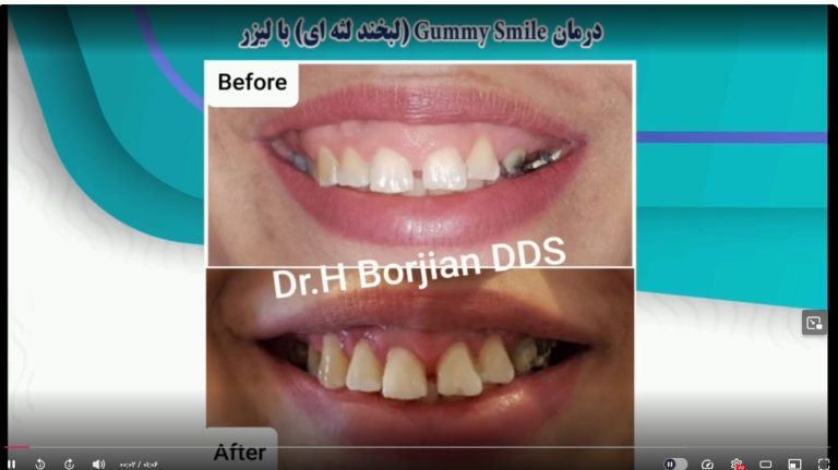 قیمت ایمپلنت اصفهان | بهترین ایمپلنت اصفهان | ایمپلنت دندان سوئیسی در اصفهان | لبخند لثه ای با لیزر دکتر حسین برجیان بهترین متخصص ایمپلنت اصفهان