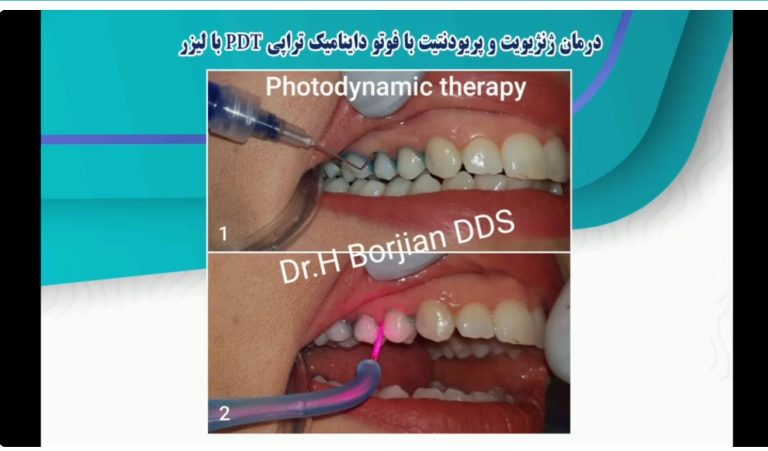 قیمت ایمپلنت اصفهان | بهترین ایمپلنت اصفهان | ایمپلنت دندان سوئیسی در اصفهان | PDTبا لیزر درمان لثه با لیزر دکتر حسین برجیان بهتربن متخصص ایمپلنت اصفهان