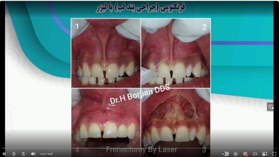 قیمت ایمپلنت اصفهان | بهترین ایمپلنت اصفهان | ایمپلنت دندان سوئیسی در اصفهان | فرنکتومی(جراحی بند لب) با لیزر دکتر حسین برجیان بهترین متخصص ایمپلنت اصفهان