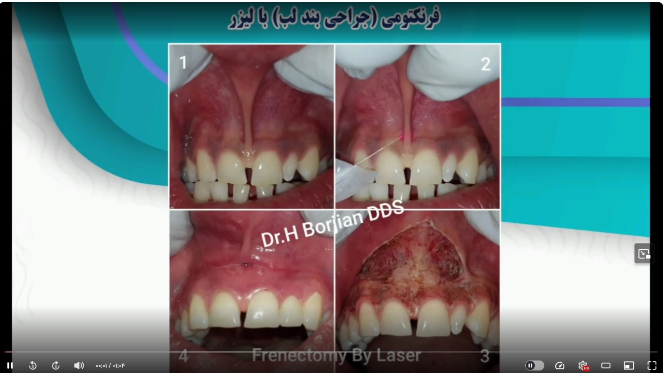 قیمت ایمپلنت اصفهان | بهترین ایمپلنت اصفهان | ایمپلنت دندان سوئیسی در اصفهان | فرنکتومی(جراحی بند لب) با لیزر دکتر حسین برجیان بهترین متخصص ایمپلنت اصفهان