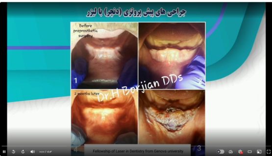 قیمت ایمپلنت اصفهان | بهترین ایمپلنت اصفهان | ایمپلنت دندان سوئیسی در اصفهان | جراحی های پیش پروتزی(دنچر)با لیزر دکتر حسین برجیان بهترین متخصص ایمپلنت اصفهان