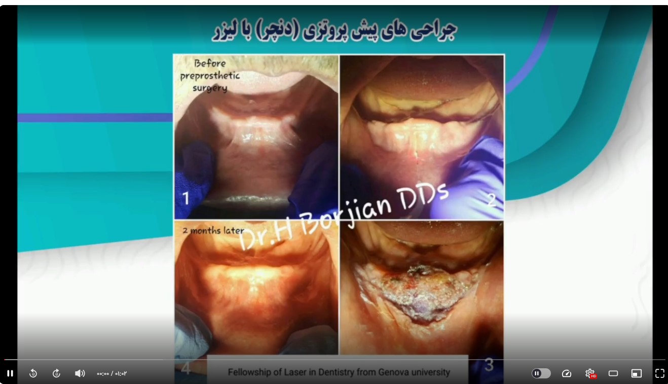 قیمت ایمپلنت اصفهان | بهترین ایمپلنت اصفهان | ایمپلنت دندان سوئیسی در اصفهان | جراحی های پیش پروتزی(دنچر)با لیزر دکتر حسین برجیان بهترین متخصص ایمپلنت اصفهان