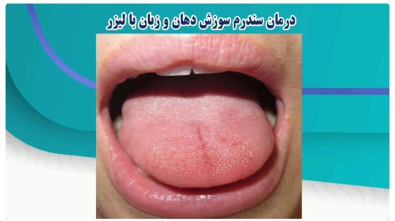 قیمت ایمپلنت اصفهان | بهترین ایمپلنت اصفهان | ایمپلنت دندان سوئیسی در اصفهان | درمان سندرم سوزش دهان و زبان با لیزر دکتر حسین برجیان بهترین متخصص ایمپلنت اصفهان