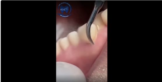 قیمت ایمپلنت اصفهان | بهترین ایمپلنت اصفهان | ایمپلنت دندان سوئیسی در اصفهان | جرمگیری دکتر حسین برجیان بهترین دندانپزشک اصفهان