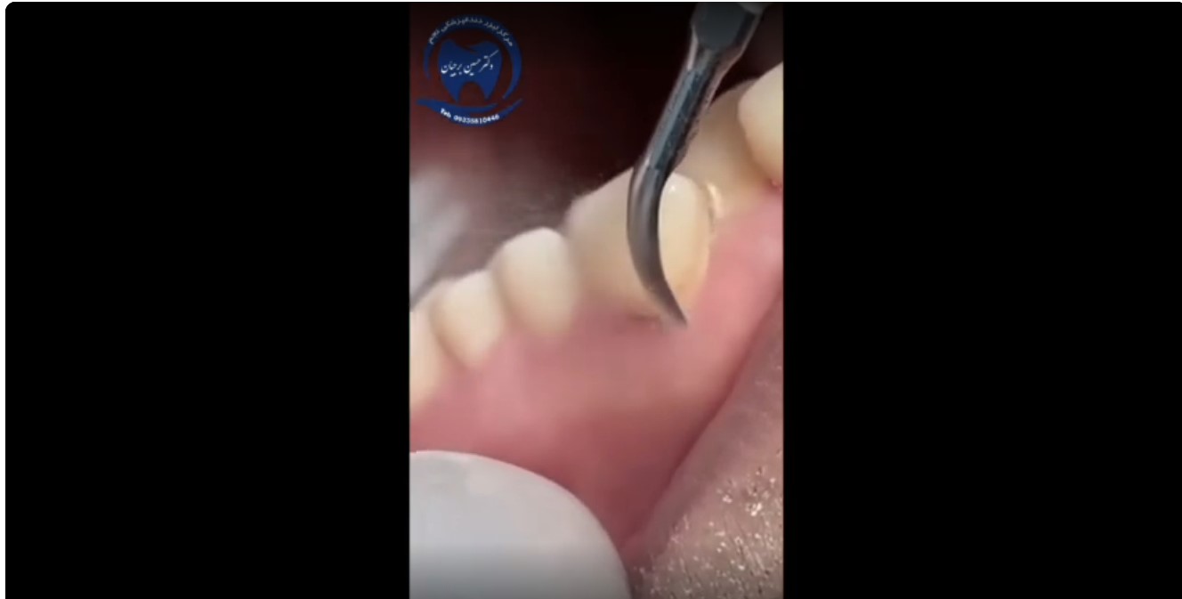 قیمت ایمپلنت اصفهان | بهترین ایمپلنت اصفهان | ایمپلنت دندان سوئیسی در اصفهان | جرمگیری دکتر حسین برجیان بهترین دندانپزشک اصفهان