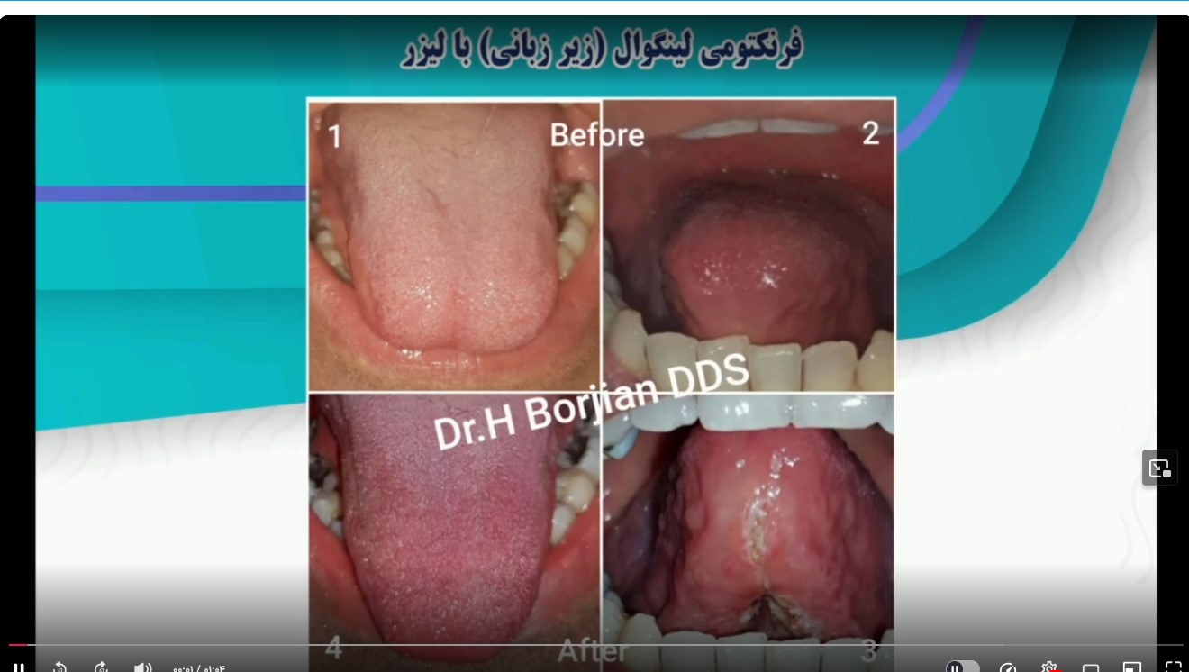 قیمت ایمپلنت اصفهان | بهترین ایمپلنت اصفهان | ایمپلنت دندان سوئیسی در اصفهان | فرنکتومی لینگوال(زیر زبانی)با لیزر دکتر حسین برجیان بهترین متخصص ایمپلنت اصفهان