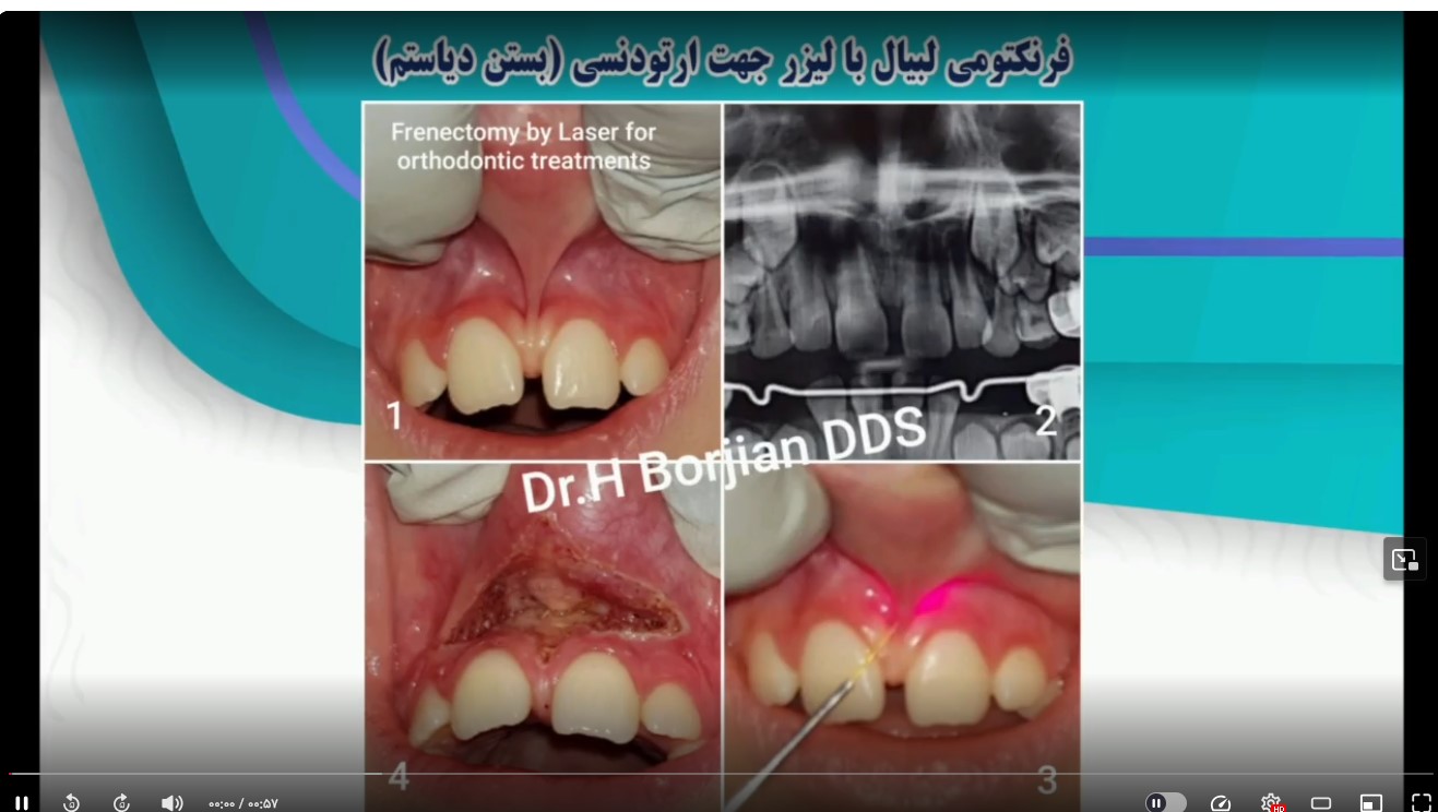 قیمت ایمپلنت اصفهان | بهترین ایمپلنت اصفهان | ایمپلنت دندان سوئیسی در اصفهان | فرنکتومی لبیال با لیزر دکتر حسین برجیان بهترین متخصص ایمپلنت اصفهان