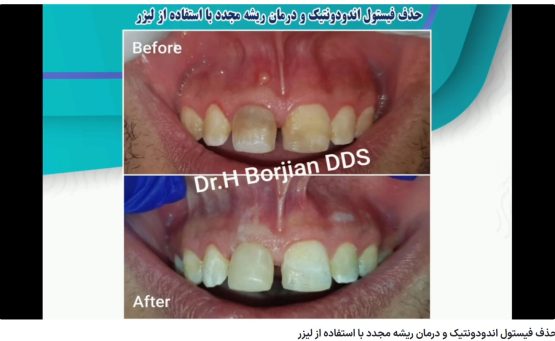 قیمت ایمپلنت اصفهان | بهترین ایمپلنت اصفهان | ایمپلنت دندان سوئیسی در اصفهان | گزینه (محتوای نامناسب برای کودکان) برای این ویدیو فعال است. حذف فیستول اندودونتیک و درمان ریشه مجدد با استفاده از لیزر دکتر حسین برجیان بهترین متخصص ایمپلنت اصفهان