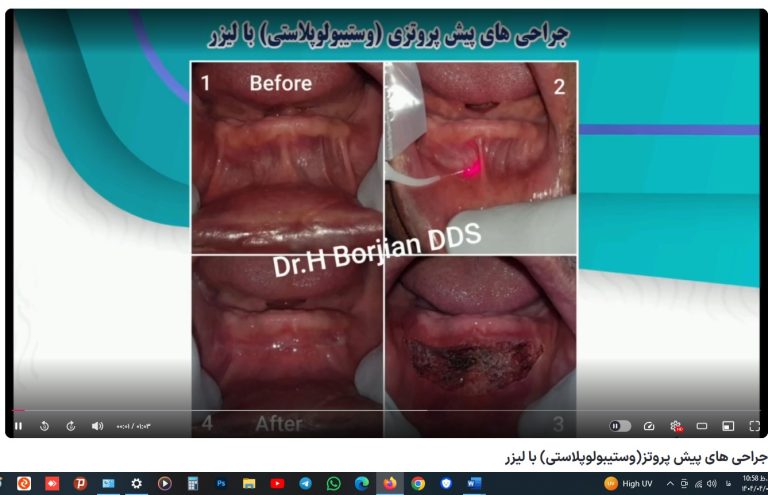 قیمت ایمپلنت اصفهان | بهترین ایمپلنت اصفهان | ایمپلنت دندان سوئیسی در اصفهان | جراحی های پیش پروتز(وستیبولوپلاستی) با لیزر دکتر حسین برجیان بهترین متخصص ایمپلنت اصفهان