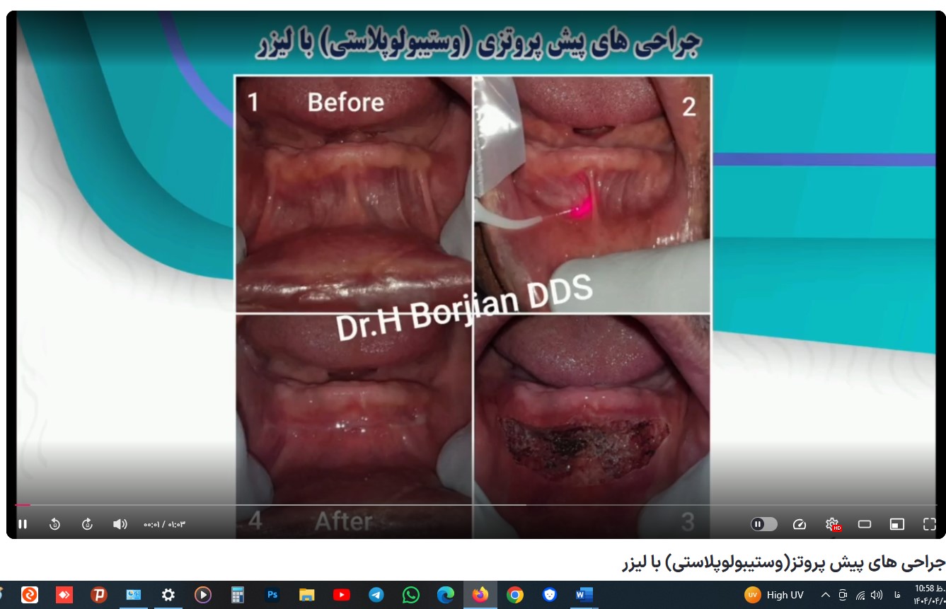 قیمت ایمپلنت اصفهان | بهترین ایمپلنت اصفهان | ایمپلنت دندان سوئیسی در اصفهان | جراحی های پیش پروتز(وستیبولوپلاستی) با لیزر دکتر حسین برجیان بهترین متخصص ایمپلنت اصفهان