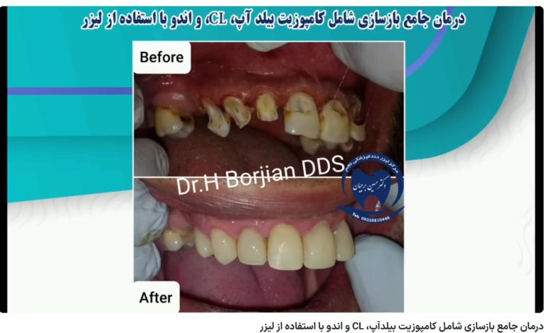 قیمت ایمپلنت اصفهان | بهترین ایمپلنت اصفهان | ایمپلنت دندان سوئیسی در اصفهان | گزینه (محتوای نامناسب برای کودکان) برای این ویدیو فعال است. درمان جامع بازسازی شامل کامپوزیت بیلدآپ، CL و اندو با استفاده از لیزر