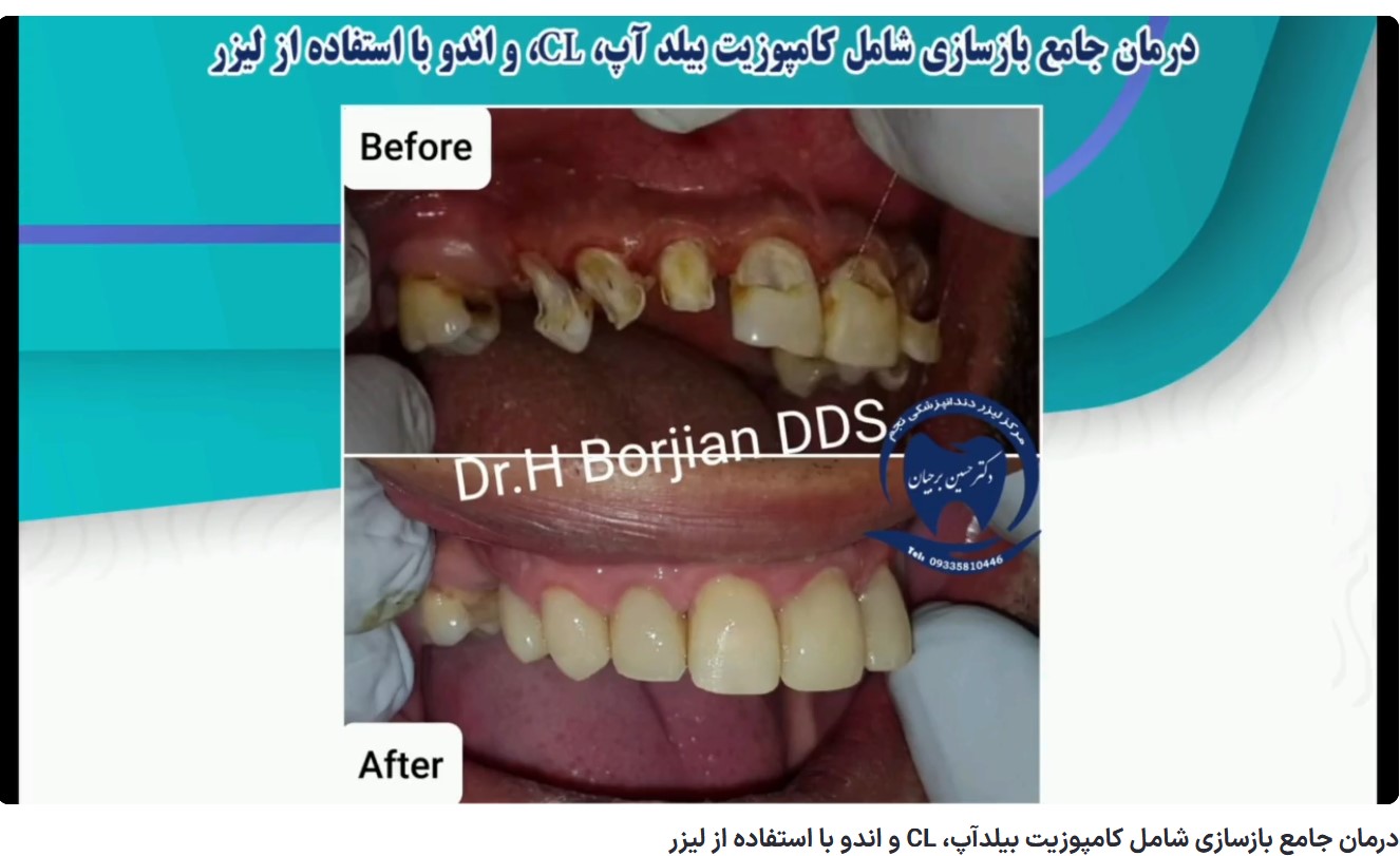 قیمت ایمپلنت اصفهان | بهترین ایمپلنت اصفهان | ایمپلنت دندان سوئیسی در اصفهان | گزینه (محتوای نامناسب برای کودکان) برای این ویدیو فعال است. درمان جامع بازسازی شامل کامپوزیت بیلدآپ، CL و اندو با استفاده از لیزر