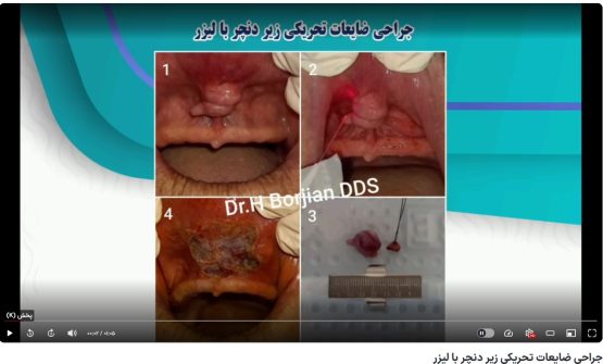 قیمت ایمپلنت اصفهان | بهترین ایمپلنت اصفهان | ایمپلنت دندان سوئیسی در اصفهان | گزینه (محتوای نامناسب برای کودکان) برای این ویدیو فعال است. جراحی ضایعات تحریکی زیر دنچر با لیزر دکتر حسین برجیان بهترین متخصص ایمپلنت اصفهان