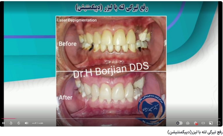 قیمت ایمپلنت اصفهان | بهترین ایمپلنت اصفهان | ایمپلنت دندان سوئیسی در اصفهان | گزینه (محتوای نامناسب برای کودکان) برای این ویدیو فعال است. رفع تیرگی لثه با لیزر(دپیگمنتیشن) دکتر حسین برجیان بهترین متخصص ایمپلنت اصفهان