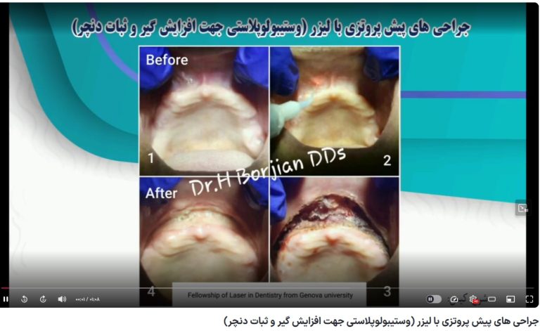قیمت ایمپلنت اصفهان | بهترین ایمپلنت اصفهان | ایمپلنت دندان سوئیسی در اصفهان | جراحی های پیش پروتزی با لیزر (وستیبولوپلاستی جهت افزایش گیر و ثبات دنچر) دکتر حسین برجیان بهترین متخصص ایمپلنت اصفهان