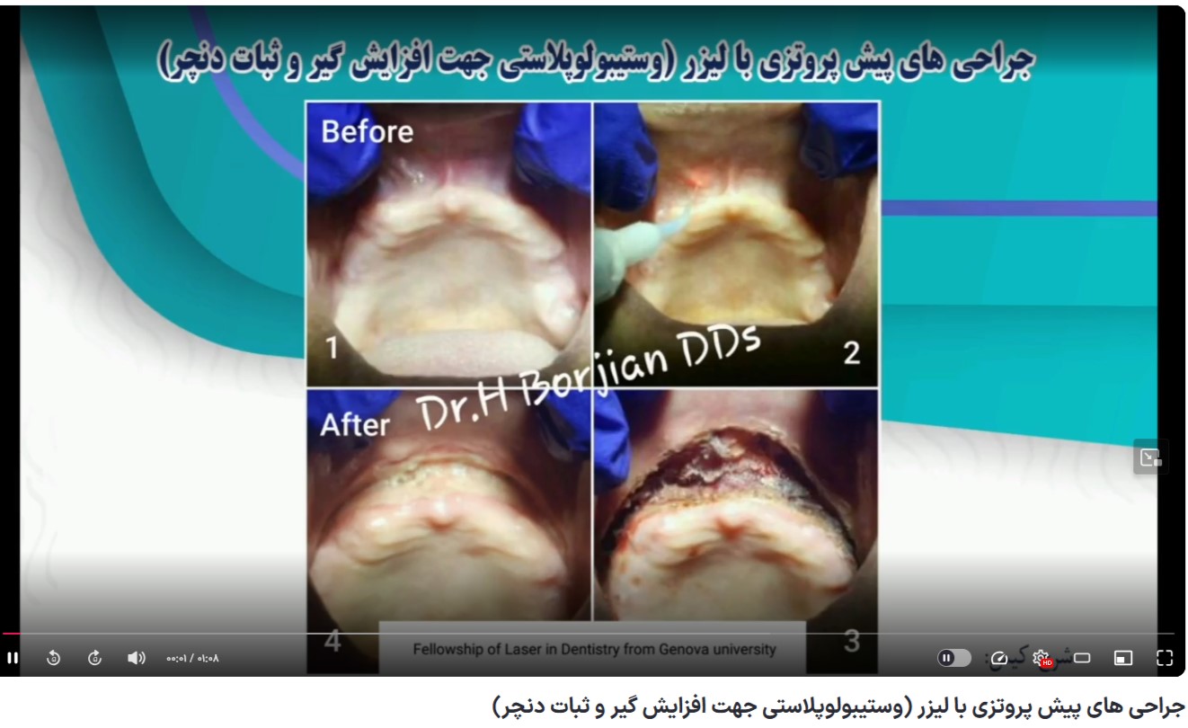 قیمت ایمپلنت اصفهان | بهترین ایمپلنت اصفهان | ایمپلنت دندان سوئیسی در اصفهان | جراحی های پیش پروتزی با لیزر (وستیبولوپلاستی جهت افزایش گیر و ثبات دنچر) دکتر حسین برجیان بهترین متخصص ایمپلنت اصفهان