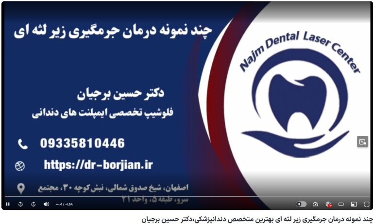 قیمت ایمپلنت اصفهان | بهترین ایمپلنت اصفهان | ایمپلنت دندان سوئیسی در اصفهان | چند نمونه درمان جرمگیری زیر لثه ای بهترین متخصص دندانپزشکی،دکتر حسین برجیان