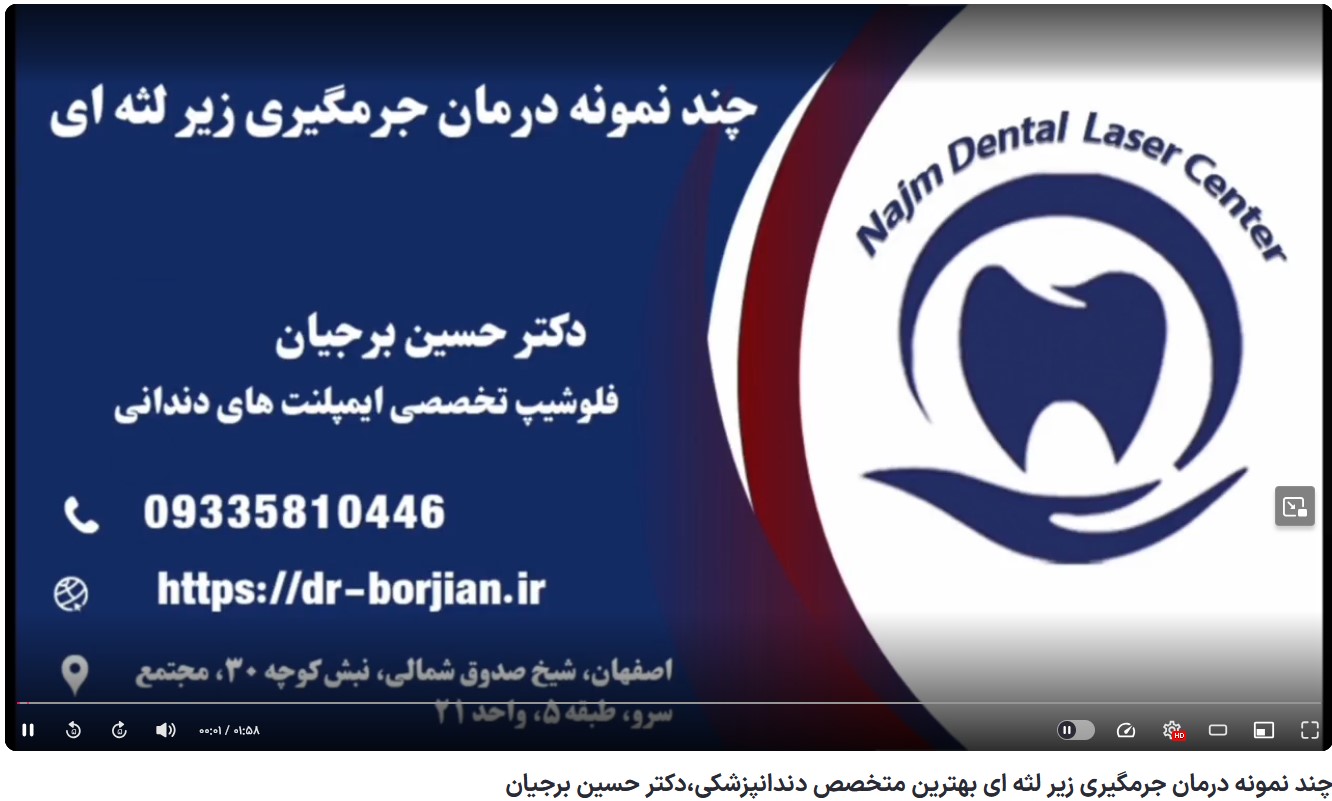 قیمت ایمپلنت اصفهان | بهترین ایمپلنت اصفهان | ایمپلنت دندان سوئیسی در اصفهان | چند نمونه درمان جرمگیری زیر لثه ای بهترین متخصص دندانپزشکی،دکتر حسین برجیان