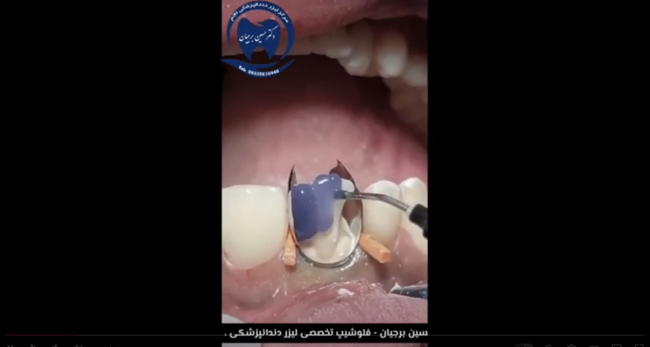 قیمت ایمپلنت اصفهان | بهترین ایمپلنت اصفهان | ایمپلنت دندان سوئیسی در اصفهان | کامپوزیت بهترین متخصص ایمپلنت اصفهان دکتر حسین برجیان