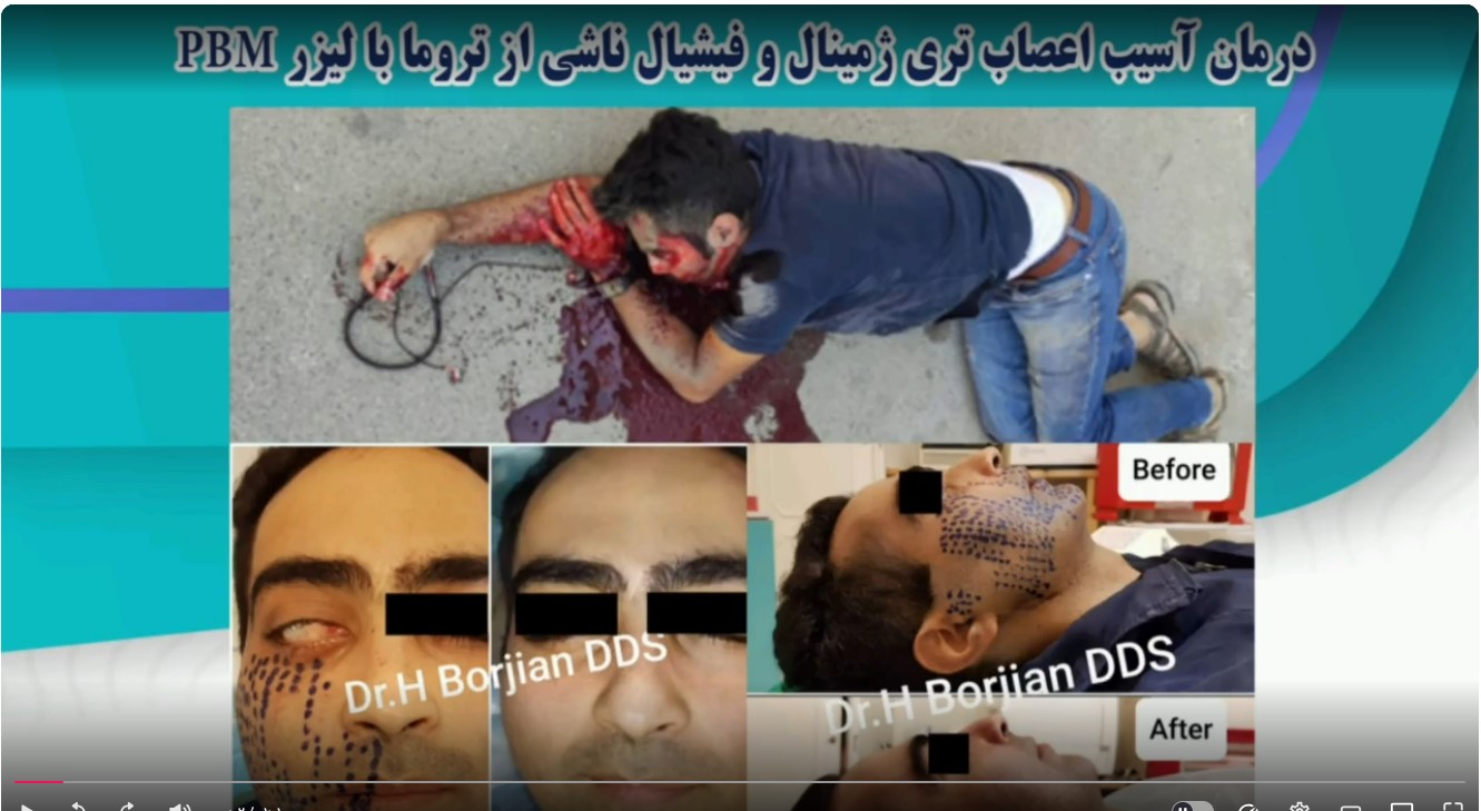 قیمت ایمپلنت اصفهان | بهترین ایمپلنت اصفهان | ایمپلنت دندان سوئیسی در اصفهان | درمان عصب با لیزر در دندانپزشکی بهترین متخصص دندانپزشکی دکتر حسین برجیان
