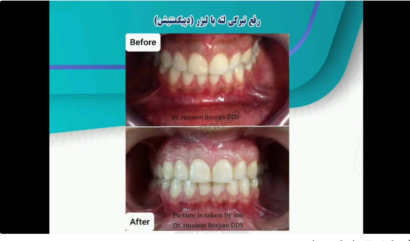قیمت ایمپلنت اصفهان | بهترین ایمپلنت اصفهان | ایمپلنت دندان سوئیسی در اصفهان | رفع تیرگی لثه بهترین متخصص دندانپزشکی