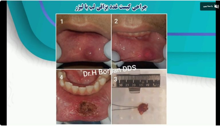 قیمت ایمپلنت اصفهان | بهترین ایمپلنت اصفهان | ایمپلنت دندان سوئیسی در اصفهان | جراحی کسیت غدد لب با لیزر دکتر حسین برجیان بهترین متخصص دندانپزشکی اصفهان