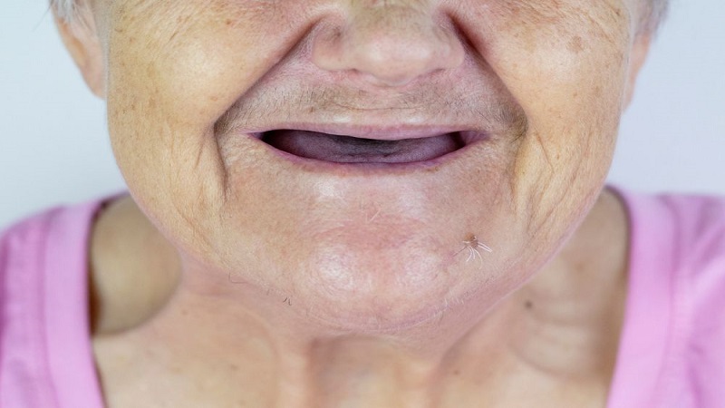 قیمت ایمپلنت اصفهان | بهترین ایمپلنت اصفهان | ایمپلنت دندان سوئیسی در اصفهان | بی دندانی 