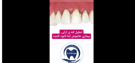 قیمت ایمپلنت اصفهان | بهترین ایمپلنت اصفهان | ایمپلنت دندان سوئیسی در اصفهان | تحلیل لثه ارثی متخصص لثه و ایمپلنت اصفهان دکتر حسین برجیان