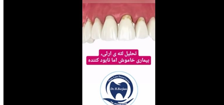 قیمت ایمپلنت اصفهان | بهترین ایمپلنت اصفهان | ایمپلنت دندان سوئیسی در اصفهان | تحلیل لثه ارثی متخصص لثه و ایمپلنت اصفهان دکتر حسین برجیان
