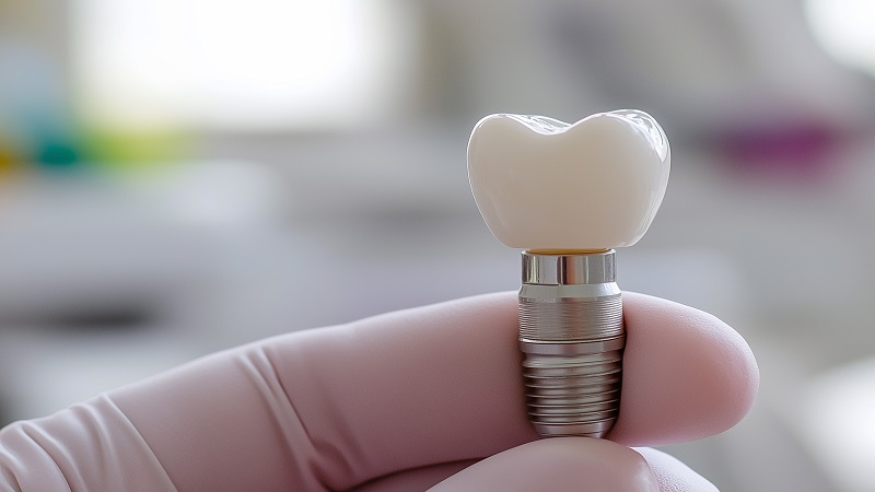 قیمت ایمپلنت اصفهان | بهترین ایمپلنت اصفهان | ایمپلنت دندان سوئیسی در اصفهان | عوارض ایمپلنت دندان