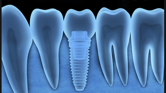 قیمت ایمپلنت اصفهان | بهترین ایمپلنت اصفهان | ایمپلنت دندان سوئیسی در اصفهان | کاشت دندان دیجیتال با کمترین جراحی