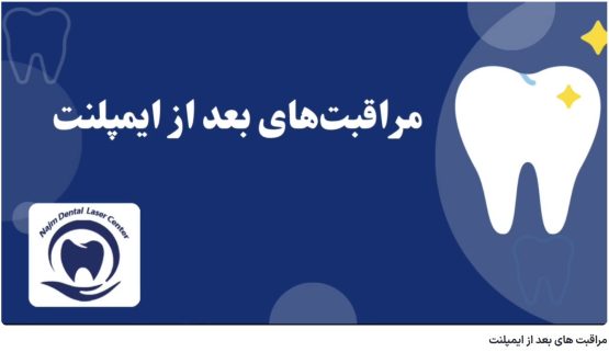 قیمت ایمپلنت اصفهان | بهترین ایمپلنت اصفهان | ایمپلنت دندان سوئیسی در اصفهان | مراقبت های بعد از ایمپلنت دکتر حسین برجیان، بهترین متخصص ایمپلنت اصفهان،تلفن تماس: 09138690321