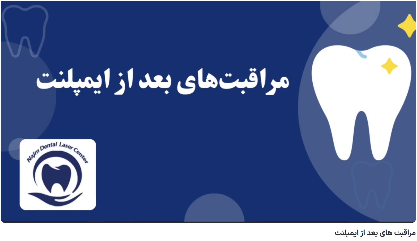قیمت ایمپلنت اصفهان | بهترین ایمپلنت اصفهان | ایمپلنت دندان سوئیسی در اصفهان | مراقبت های بعد از ایمپلنت دکتر حسین برجیان، بهترین متخصص ایمپلنت اصفهان،تلفن تماس: 09138690321
