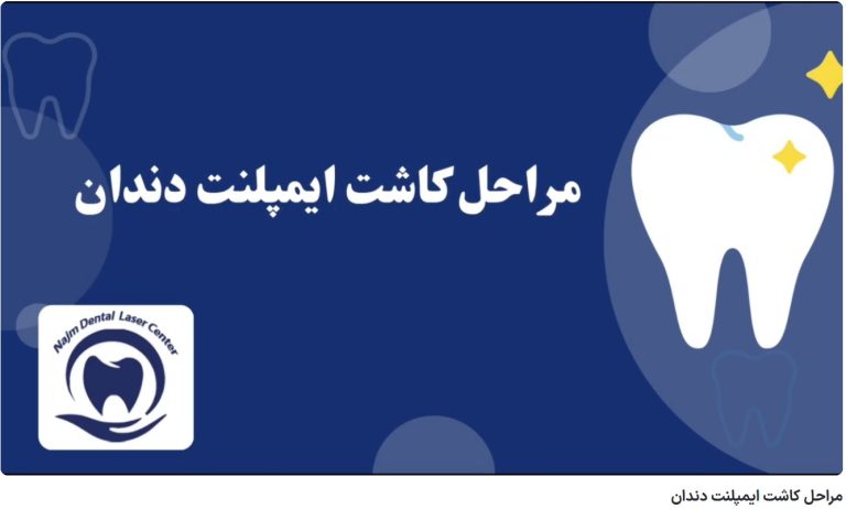 قیمت ایمپلنت اصفهان | بهترین ایمپلنت اصفهان | ایمپلنت دندان سوئیسی در اصفهان | مراحل کاشت ایمپلنت دندان دکتر حسین برجیان، بهترین متخصص ایمپلنت اصفهان،تلفن تماس: 09138690321