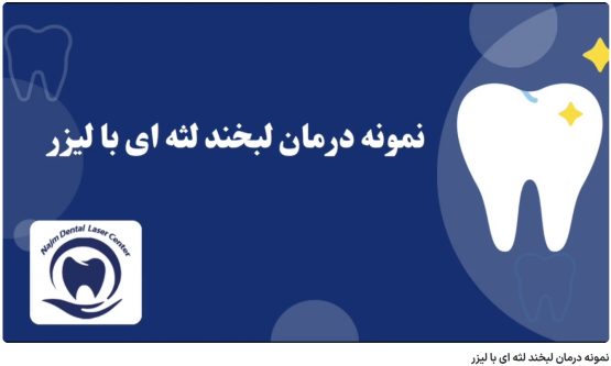 قیمت ایمپلنت اصفهان | بهترین ایمپلنت اصفهان | ایمپلنت دندان سوئیسی در اصفهان | نمونه درمان لبخند لثه ای با لیزر دکتر حسین برجیان، بهترین متخصص ایمپلنت اصفهان،تلفن تماس: 09138690321