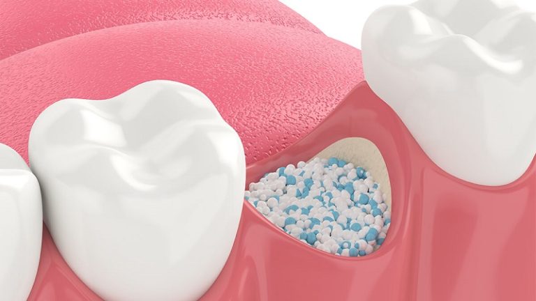 قیمت ایمپلنت اصفهان | بهترین ایمپلنت اصفهان | ایمپلنت دندان سوئیسی در اصفهان | رعایت بهداشت و مراقبت‌های بعد از پودر استخوان در ایمپلنت