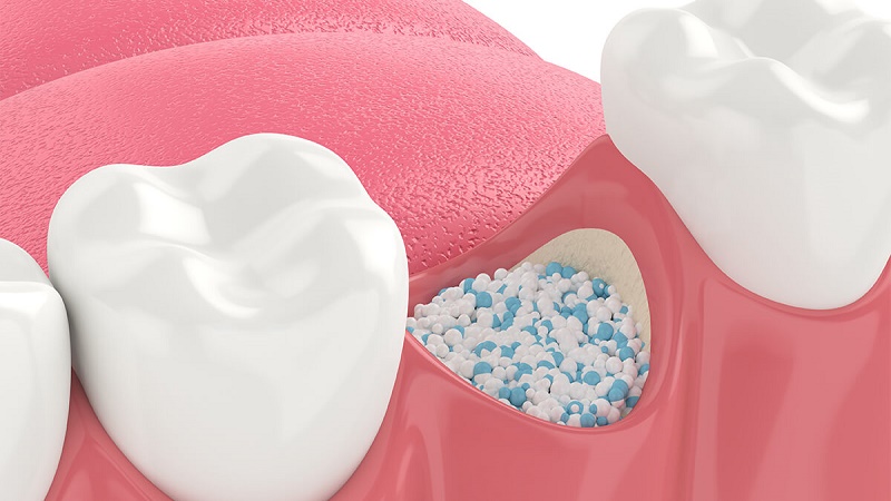 قیمت ایمپلنت اصفهان | بهترین ایمپلنت اصفهان | ایمپلنت دندان سوئیسی در اصفهان | رعایت بهداشت و مراقبت‌های بعد از پودر استخوان در ایمپلنت