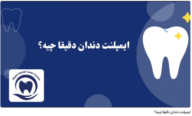 قیمت ایمپلنت اصفهان | بهترین ایمپلنت اصفهان | ایمپلنت دندان سوئیسی در اصفهان | ایمپلنت دندان دقیقا چیه؟ دکتر حسین برجیان، بهترین متخصص ایمپلنت اصفهان، تلفن تماس: 09138690321