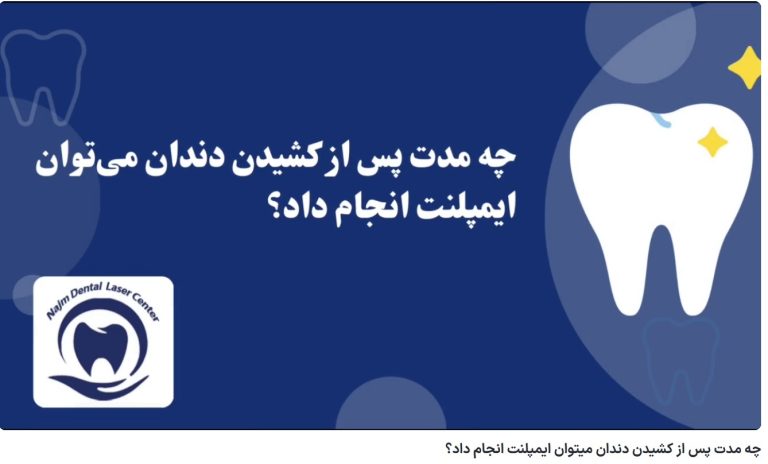 قیمت ایمپلنت اصفهان | بهترین ایمپلنت اصفهان | ایمپلنت دندان سوئیسی در اصفهان | چه مدت پس از کشیدن دندان میتوان ایمپلنت انجام داد؟ دکتر حسین برجیان، بهترین متخصص ایمپلنت اصفهان، تلفن تماس: 09138690321