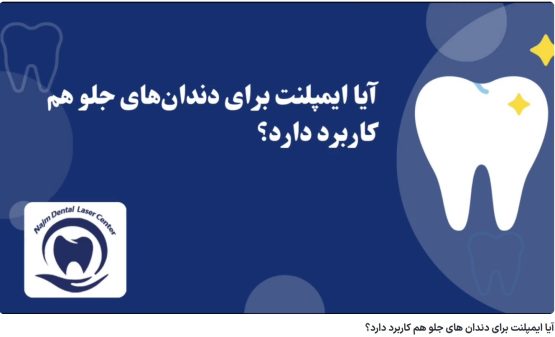 قیمت ایمپلنت اصفهان | بهترین ایمپلنت اصفهان | ایمپلنت دندان سوئیسی در اصفهان | آیا ایمپلنت برای دندان های جلو هم کاربرد دارد؟ دکتر حسین برجیان، بهترین متخصص ایمپلنت اصفهان، تلفن تماس: 09138690321