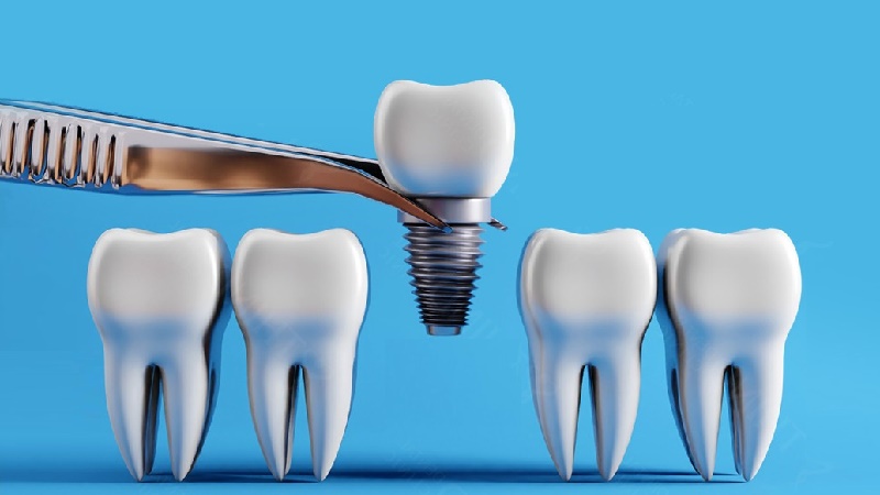 قیمت ایمپلنت اصفهان | بهترین ایمپلنت اصفهان | ایمپلنت دندان سوئیسی در اصفهان | ایمپلنت تک دندان