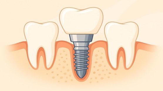 قیمت ایمپلنت اصفهان | بهترین ایمپلنت اصفهان | ایمپلنت دندان سوئیسی در اصفهان | بازسازی استخوان فک و موفقیت ایمپلنت دندان
