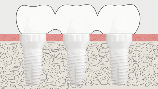 قیمت ایمپلنت اصفهان | بهترین ایمپلنت اصفهان | ایمپلنت دندان سوئیسی در اصفهان | روکش ایمپلنت دندان تمام سرامیکی