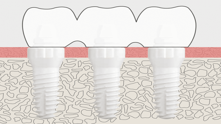 قیمت ایمپلنت اصفهان | بهترین ایمپلنت اصفهان | ایمپلنت دندان سوئیسی در اصفهان | روکش ایمپلنت دندان تمام سرامیکی
