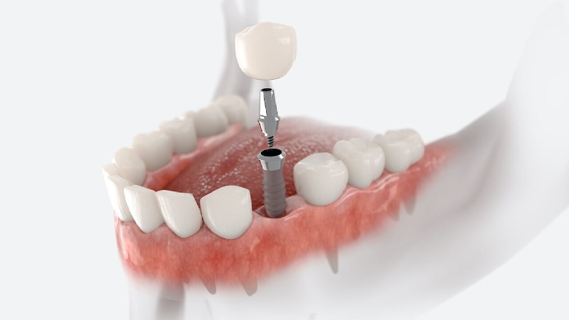 قیمت ایمپلنت اصفهان | بهترین ایمپلنت اصفهان | ایمپلنت دندان سوئیسی در اصفهان | چالش‌های کاشت ایمپلنت فوری